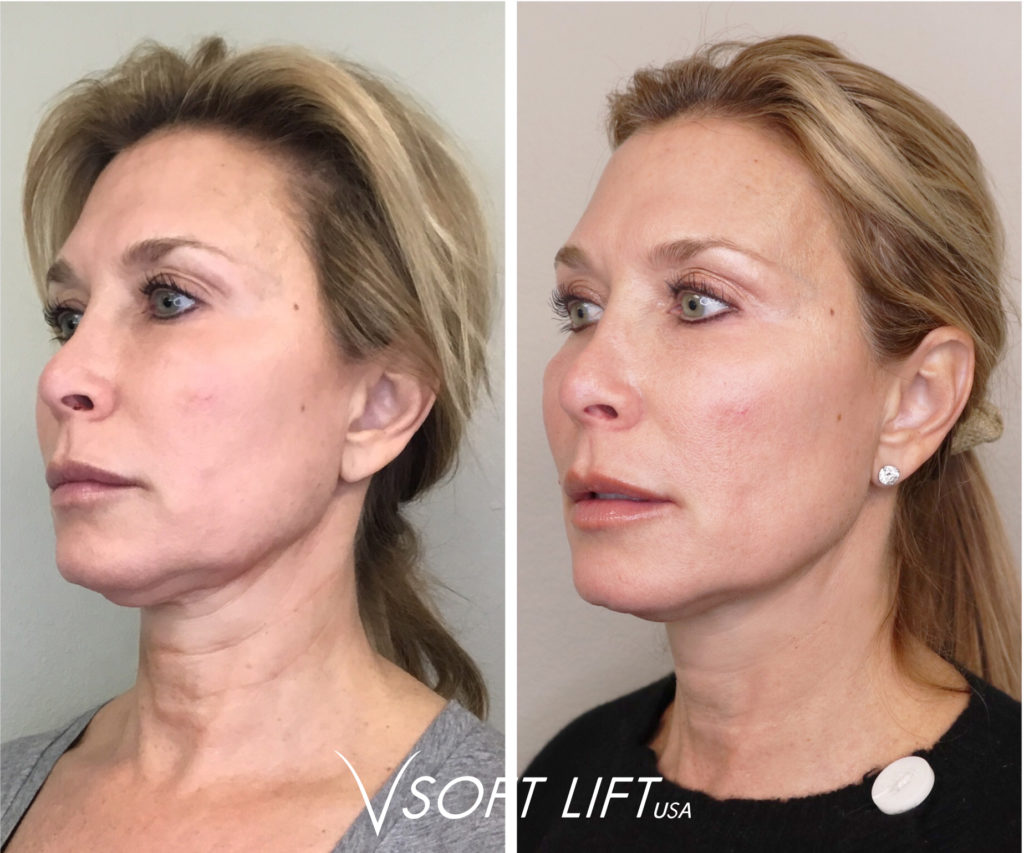 before and after picture of blonde woman with jowls lifted from neck lift pdo threading lebanon tn