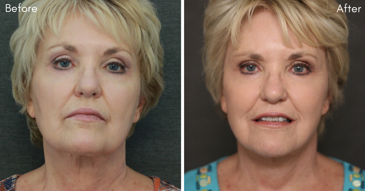 Facelift before & after mt juliet and lebanon tn