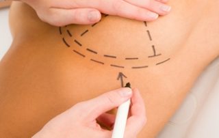 Breast reduction surgery is becoming more popular among teenagers with certain conditions.