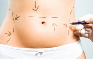 A surgeon marking a patient's stomach for weight loss surgery and fat reduction surgery at The Lett Center in Lebanon TN