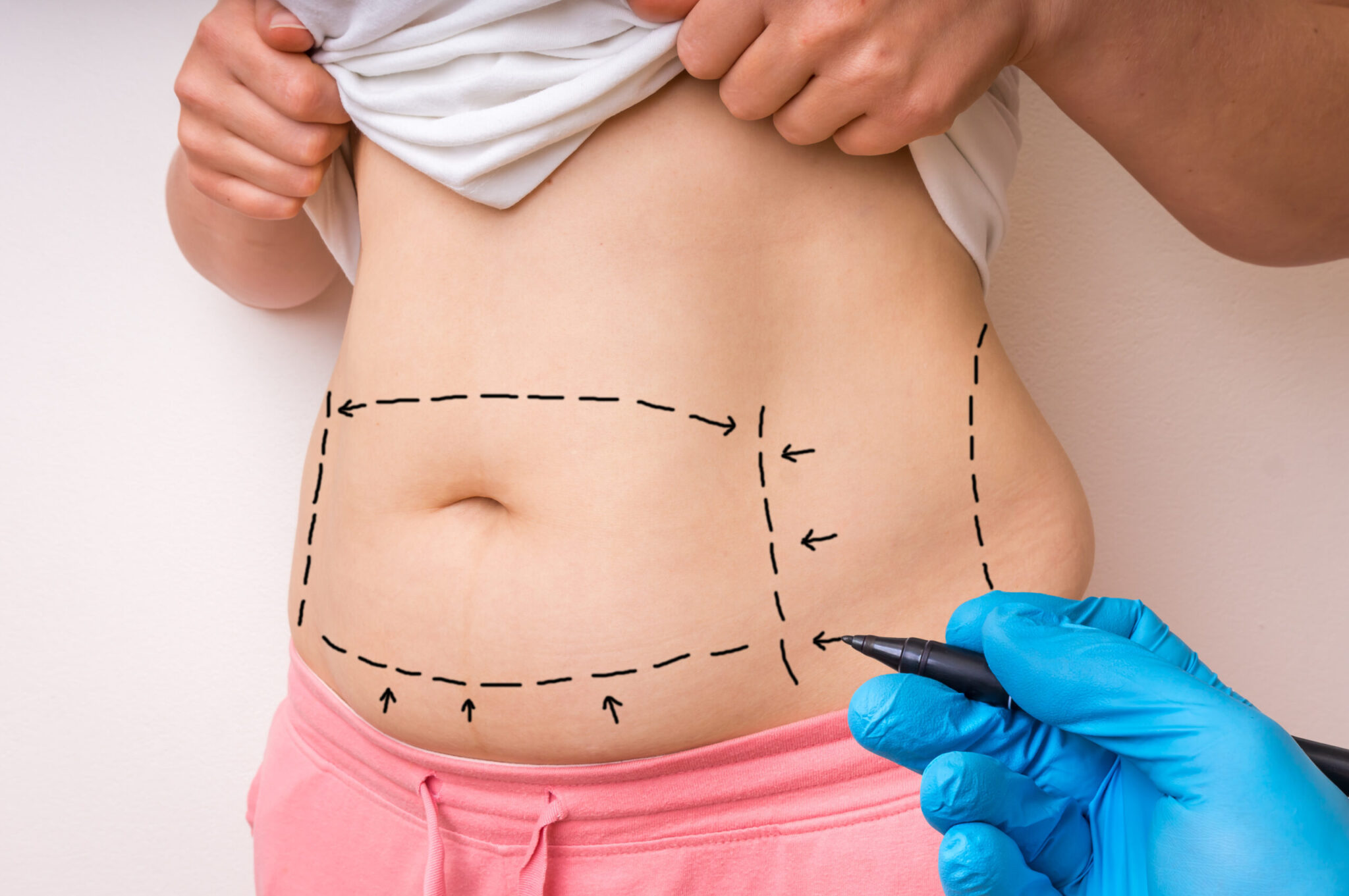 Abdomen marked up prior to tummy tuck surgery