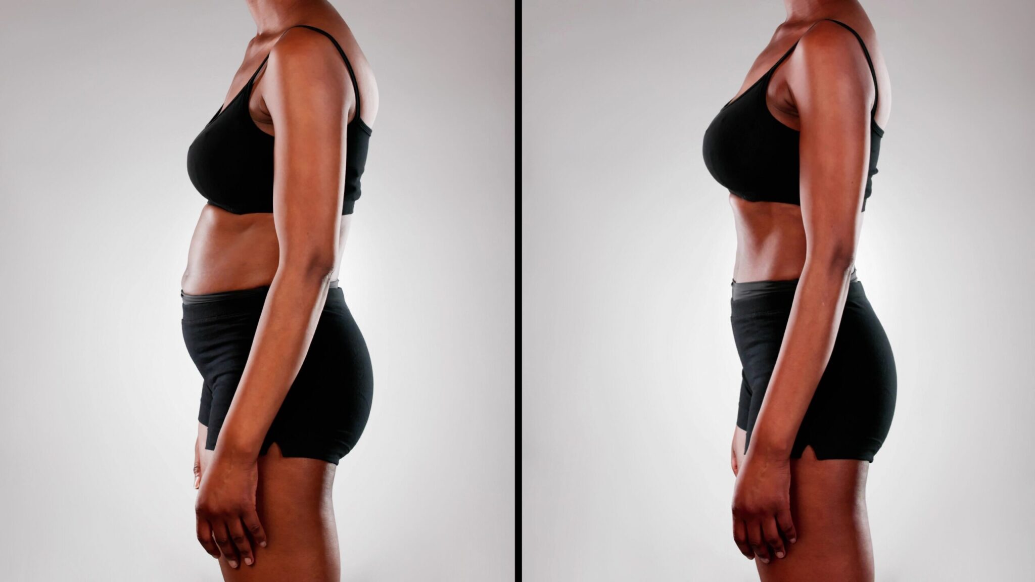 Woman before and after tummy tuck.