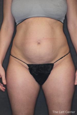 liposuction before picture