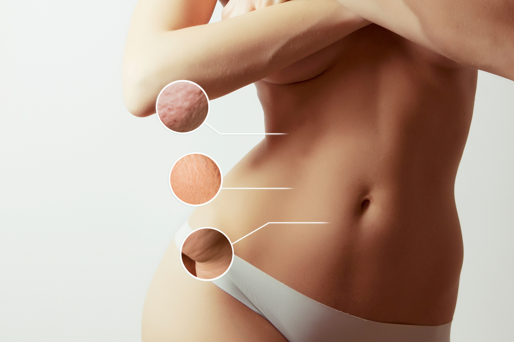 liposuction body contouring in mt juliet
