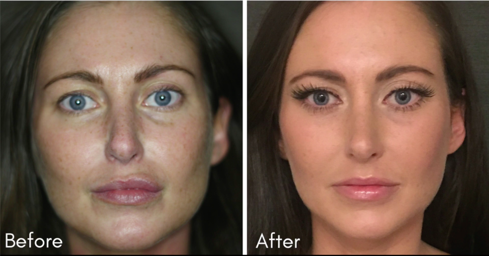 The Lett Center before and after image of injectable fillers as a comsetic tweakmen in Mt Juliet and Lebanon.png