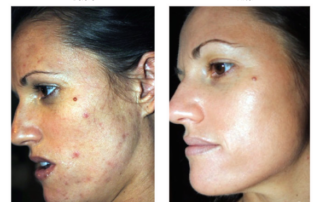 chemical peels, skin care mt juliet, the perfect derma peel