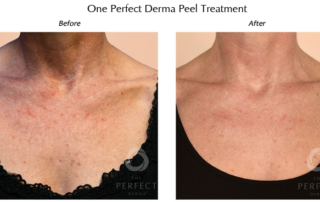 one perfect derma peel treatment at the tell center in mt juliet and lebanon tn