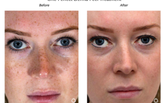 best chemical peels the perfect derma peel before & after