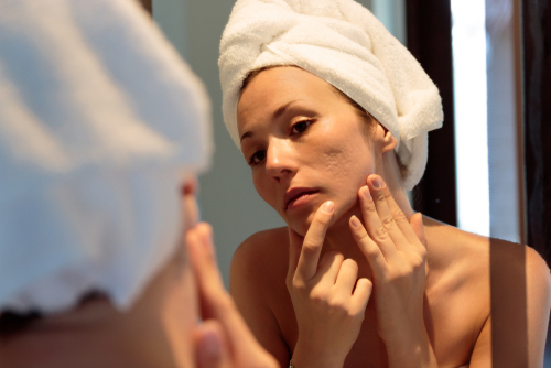 boost self confidence and remove acne scars woman with acne scars in morror