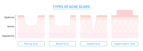 types of acne scars and how to remove them