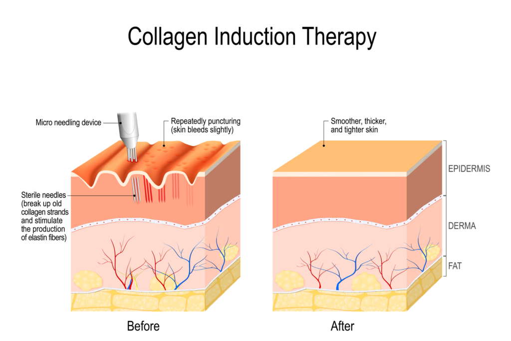 Collagen induction therapy helps reduce the effects of aging by stimulating collagen production