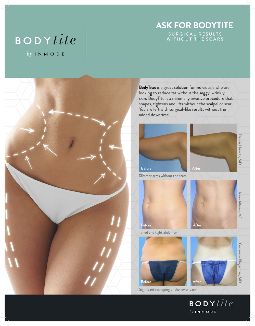 body fat reduction skin tightening before and after photos of bodytite liposuction at the lett center in mt juliet lebanon tn