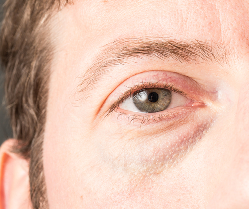 Men can fix deep eye bags with cosmetic surgery in Tennessee
