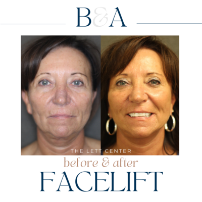 facelift before and after image