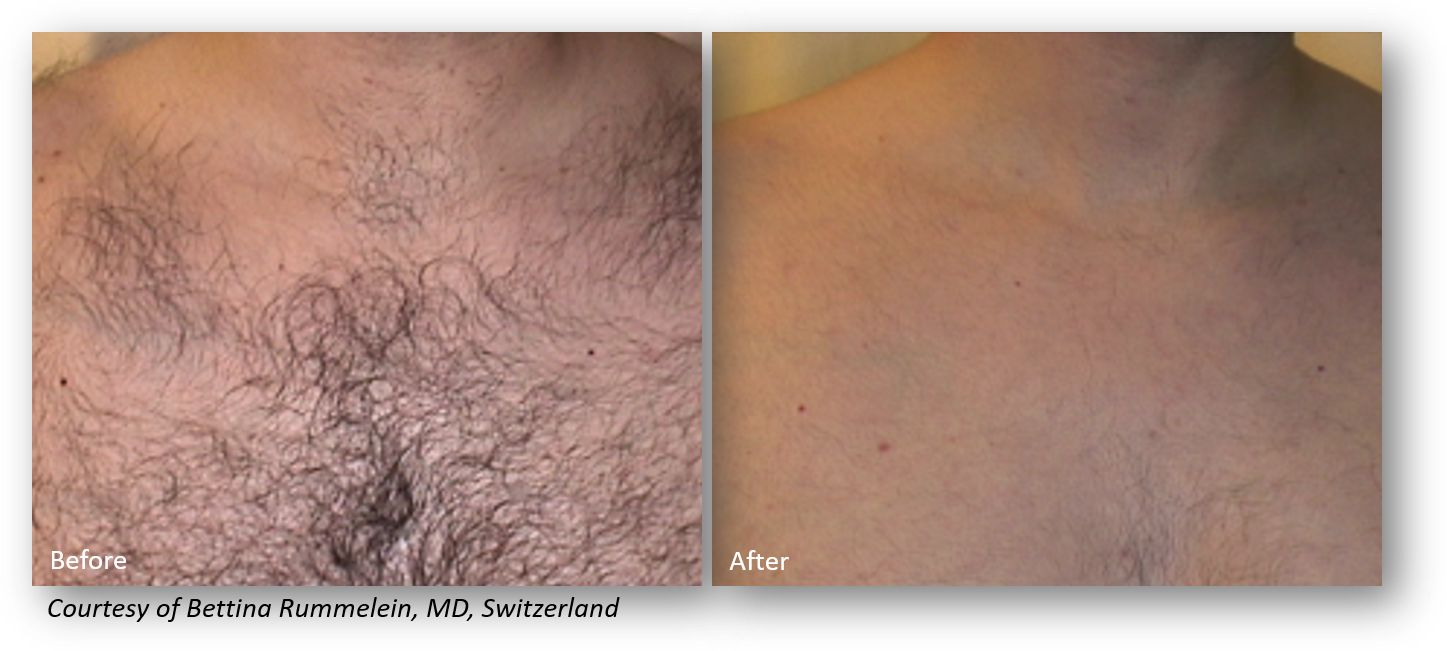 laser Hair Removal for Chest in mt juliet and lebanon tn
