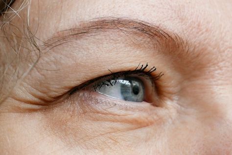 can contact lenses cause a droopy eyelid?