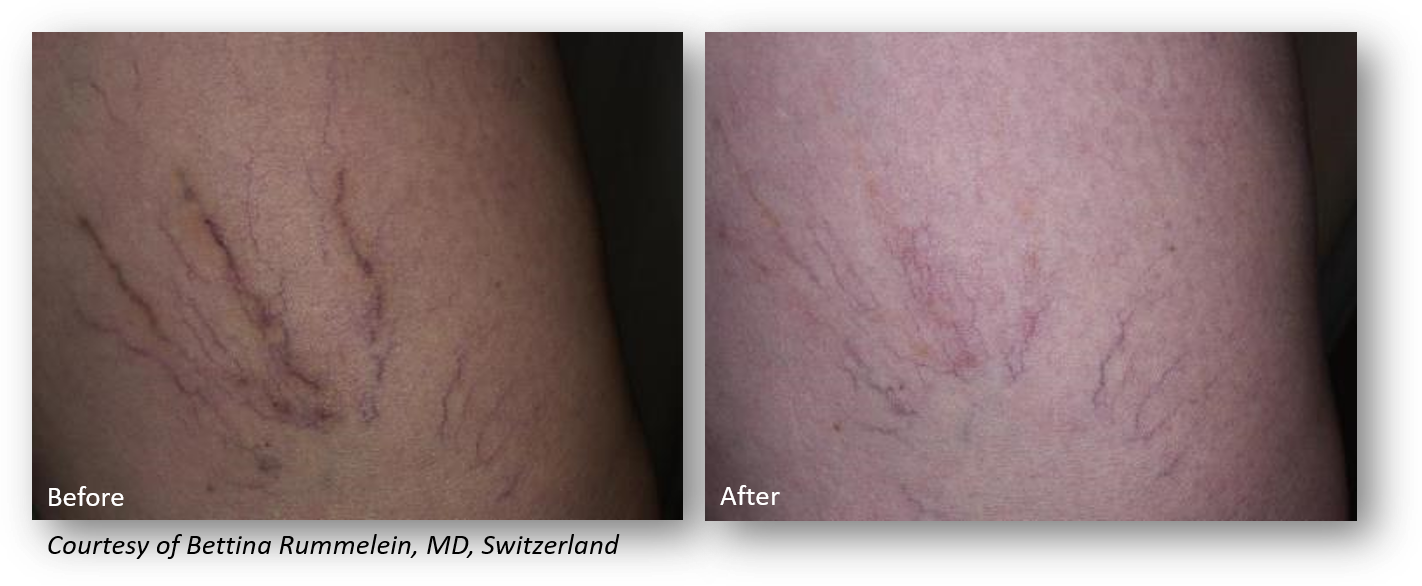 Clarity II Laser Treatments The Lett Center In Mt Juliet Lebanon TN