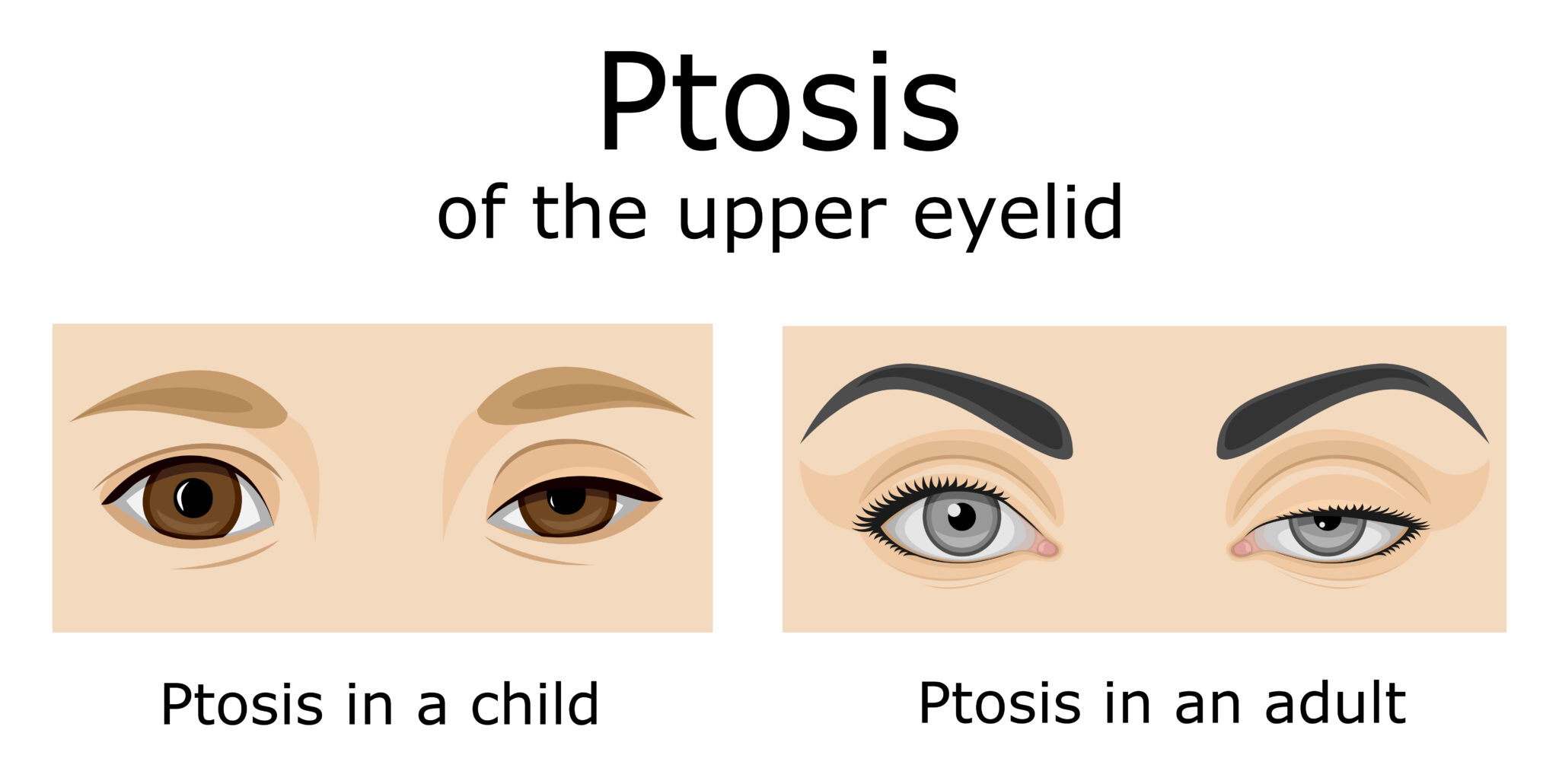 illustration of ptosis in upper eyelid in a child and in an adult side by side