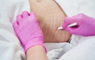 Patient during an abdominal fat reduction treatment